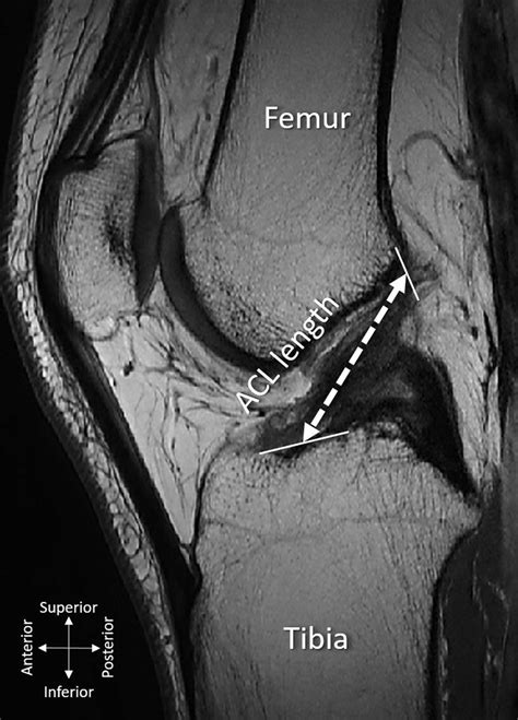 Sagittal Magnetic Resonance Imaging Section Of The Left Knee That Is