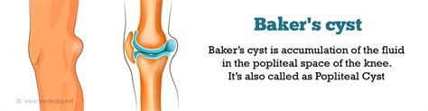 Baker S Cyst Causes Symptoms Diagnosis Treatment