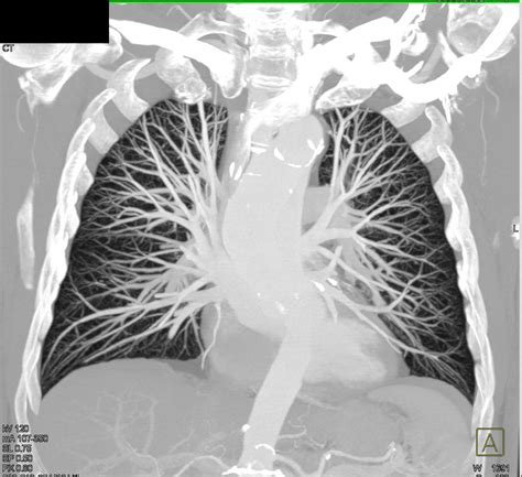 Mip Of Normal Pulmonary Vasculature Chest Case Studies Ctisus Ct