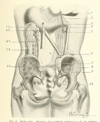 This Image Is Taken From Page 31 Of Nephrocoloptosis A D Flickr