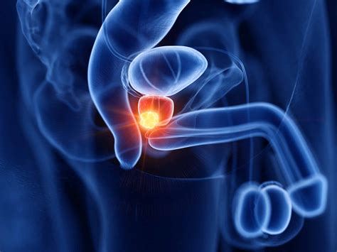 prostatakrebs symptome and behandlung isar klinikum urologie