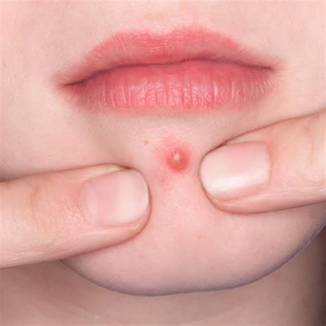 If you are into pimple popping videos (and let's face it, this is the seventh video on this list so if you made this far, you are), you know you've got a blockbuster when the zip pops all over the mirror. Pimple Popping Videos - YouTube