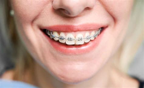 Os Benefícios Da Ortodontia Como Dentes Alinhados Promovem Saúde E Estética