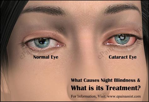 What Causes Night Blindness And What Is Its Treatment