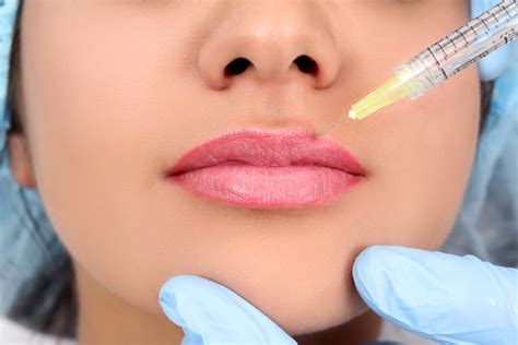 Lip Filler Leeds At Medifine Aesthetics Medifine Skin Clinic