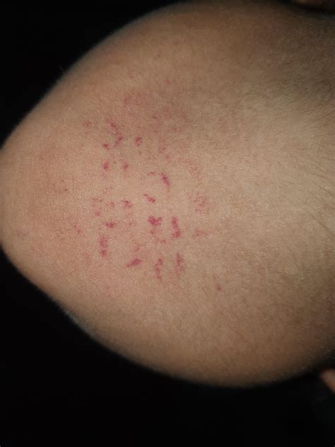 Sudden Red Spots On Skin Askdocs