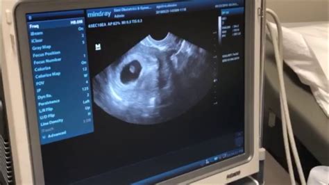 pregnant ultrasound telegraph