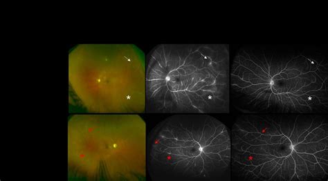 Case 2 Ultra Wide Field Uwf Pseudo Colour Fundus Photograph At