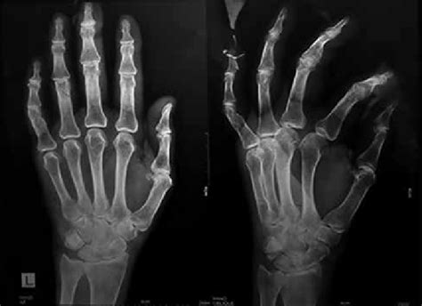 X Ray Hand Ap And Oblique View Of The Involved Left Hand Showing No