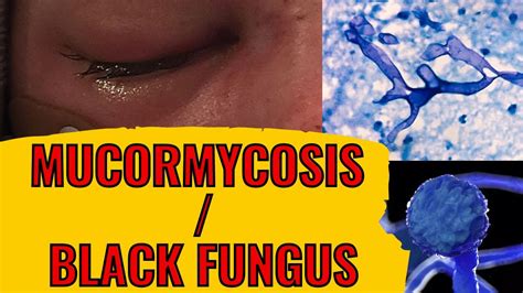 What Is Mucormycosis Symptoms Prevention And Treatment Youtube