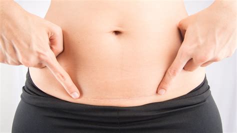 Tummy Tuck Belly Button Scab Cosmetic Surgery Tips