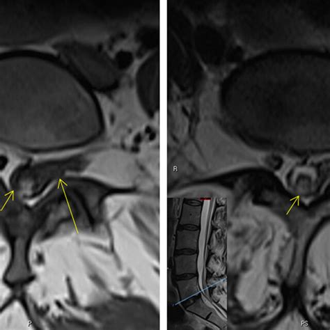 Initial Images Axial Magnetic Resonance Imaging Lumbar Spine