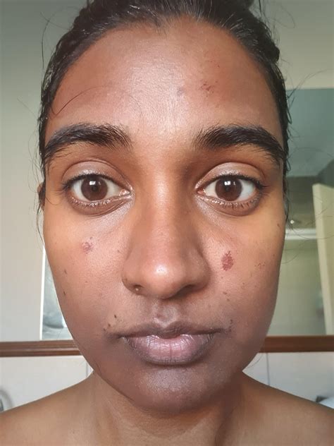 Before And After Chemical Peel Black Skin See The Wow Results