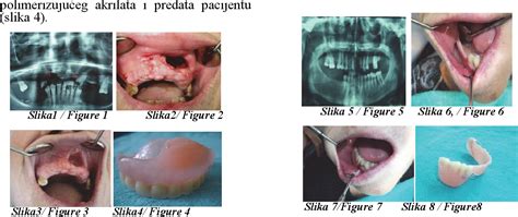 Figure 3 From Early Use Of Partial Acrylic Denture Obturator In The