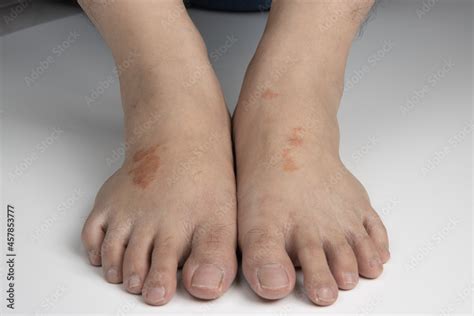 Feet Infected With Ringworm Athletes Foot Or Tinea Pedis Fungal