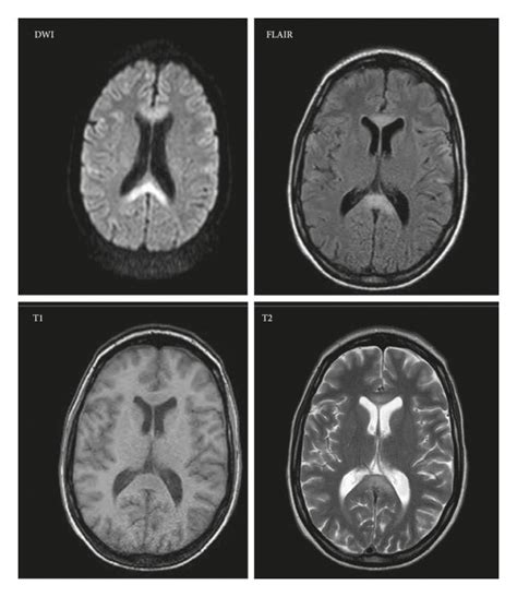 An Mri Of The Brain With A Diffusion Weighted Imaging Dwi Sequence
