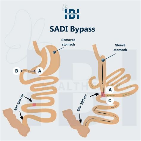 Single Anastomosis Duodenal Ileal Bypass Sadi Bypass