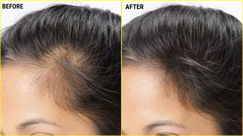 How To Make Vitamin E Hair Oil To Regrow Hair Fastcontrol Hair Fall