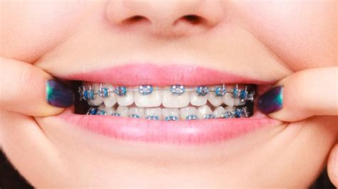 How Much Does A Full Set Of Braces Cost
