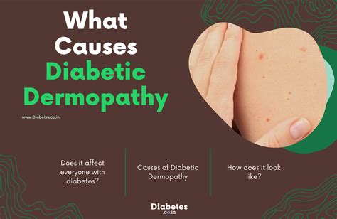 What Is Diabetes Dermopathy