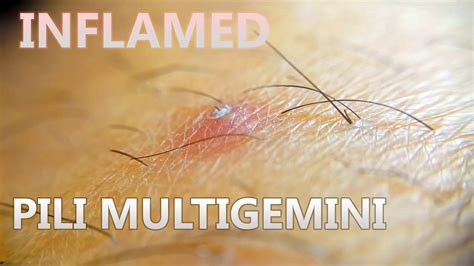 Tweezing Inflamed Pili Multigemini Ingrown Hair With Whitehead In