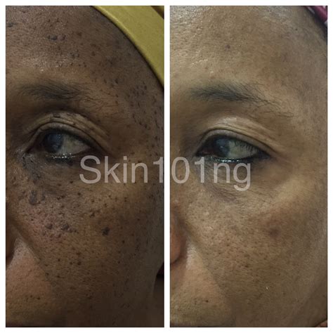 Dermatosis Papulosa Nigra Aka Dpn Removal Skin101 Center