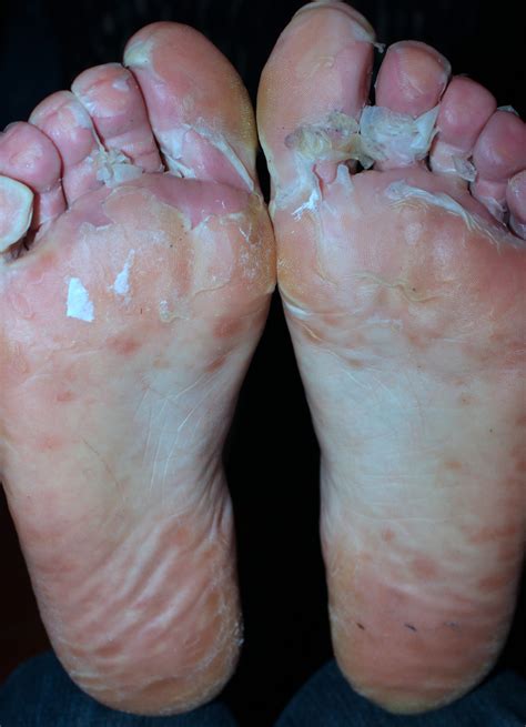 Mild Hand Foot And Mouth Disease Adult