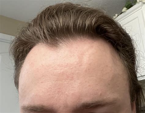 Dent/Crease in Forehead Descending from my Hairline: What Could Be the