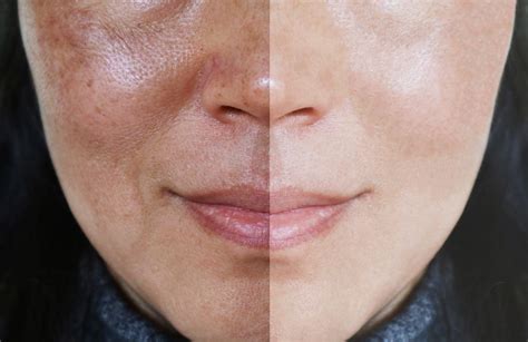 Hyperpigmentation And Melasma — The Differences And How To Treat Them