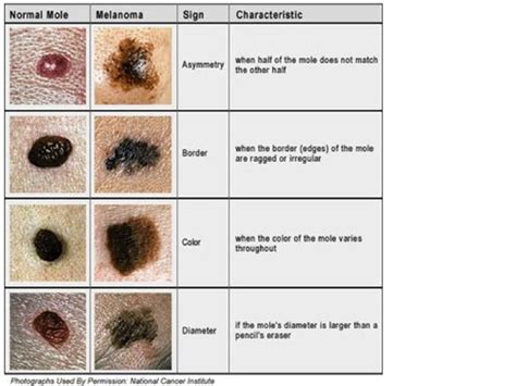 Precancerous And Malignant Skin Conditions Melanoma Kaposis Mycosis