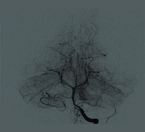 Dsa Of The Right Vertebral Artery Depicting No Abnormal Imaging