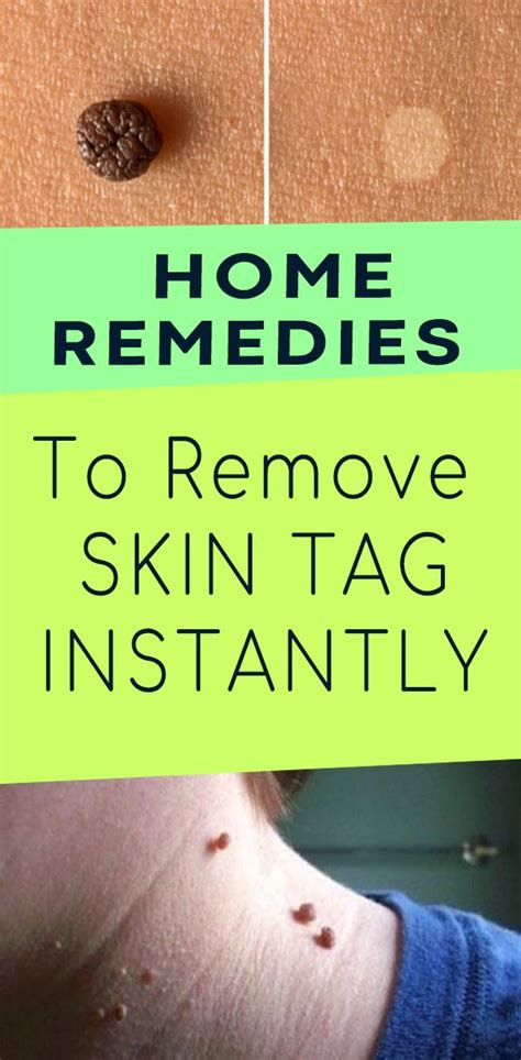 top 10 home remedies to remove skin tags naturally healthy glowing