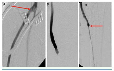 Limb Salvage Endovascular Technique In Chronic Limb Threatening