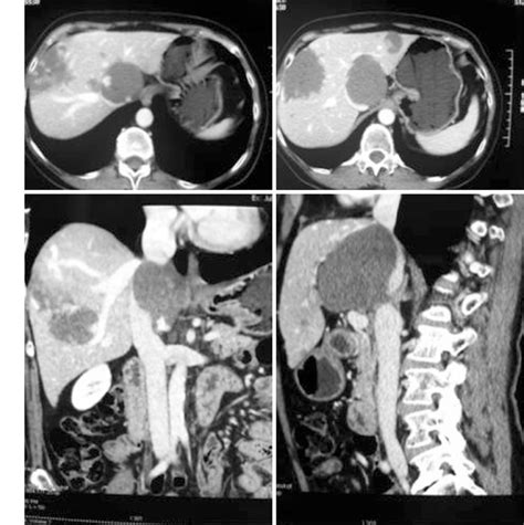 Liver Segmental Anatomy Ct Scan