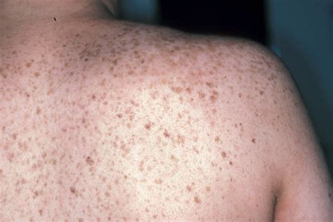 What Causes Brown Spots On Skin Zohal