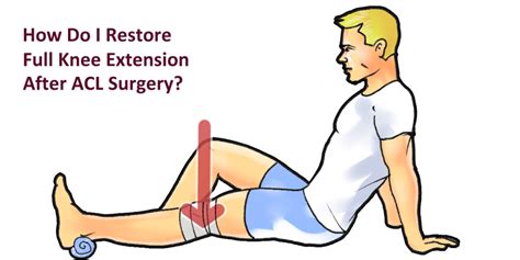 Full Knee Extension After Acl Surgery Exercises To Help You Straighten Your Knee Acl