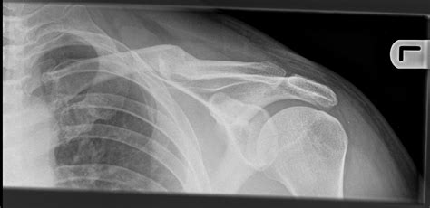 Should I Have My Clavicle Fracture Fixed
