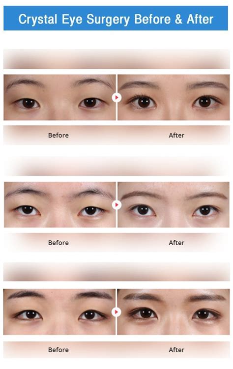 Twinkling Crystal Eyelid Surgery Eye Bag Surgery Korea The Line Clinic