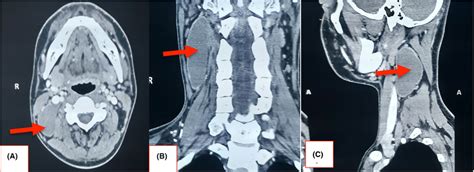 Contrast Enhance Computerized Tomography Cect Scan Of Neck A Axial