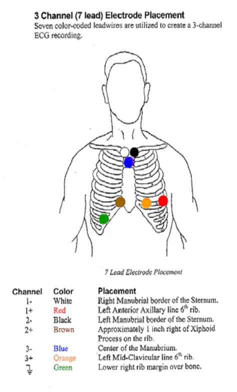 31 Holter Monitor 5 Lead Placement Diagram Worksheet Cloud