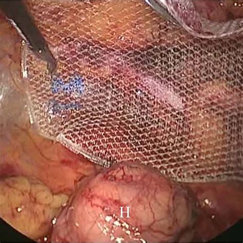 Intraoperative Findings A The Hernia Sac H Had Herniated Into The