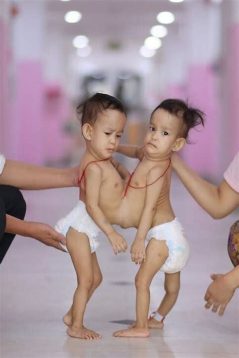 these conjoined twins undergo six hours of surgery see them now