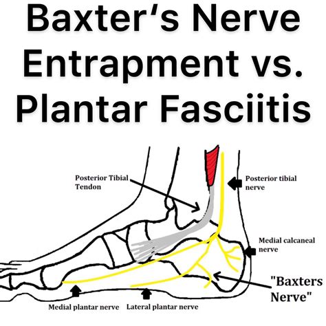 Baxter`s Nerve Sports Physiotherapy Stefan Duell Facebook