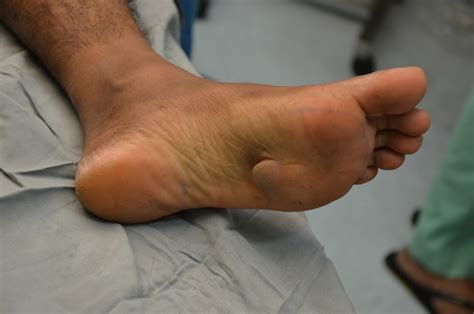 Crush Injury Foot Lower Limb Injuries And Limb Salvage Rare Soft