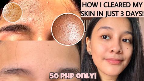 How To Get Rid Of Forehead Acne Fast How To Get Rid Of Pimples On