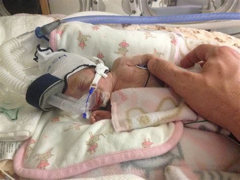 Miracle Baby Born Premature At 25 Weeks Is Beating The Odds