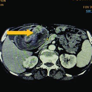 Axial Contrast Enhanced Ct Cect Showing Bowel Within Bowel Appearance