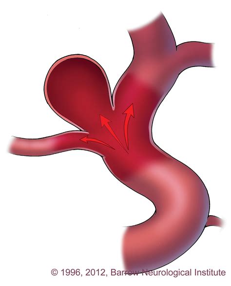 Aneurysm Aneurysms And Arteriovenous Malformations Stanford Health