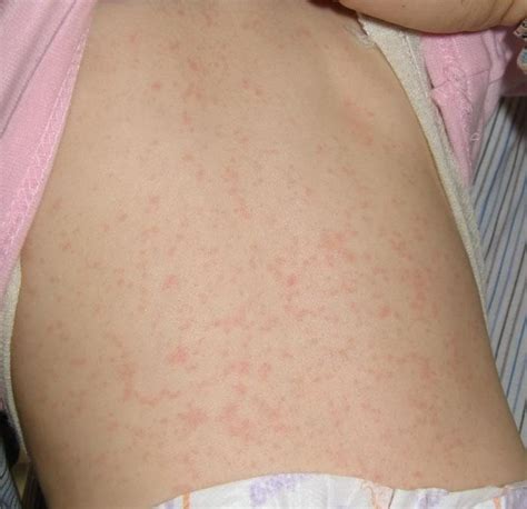 Baby Rash Pictures Causes Treatments Advice