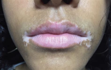 Perioral Köebner Phenomenon Following Lip Licking Dermatitis In A
